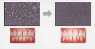 歯のクリーニングとは？