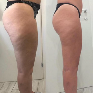 redessine la silhouette et reduit la cellulite
