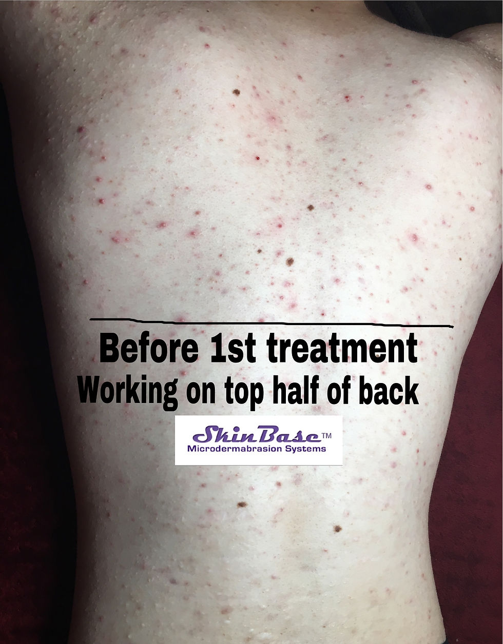 MICRODERMABRASION (1)