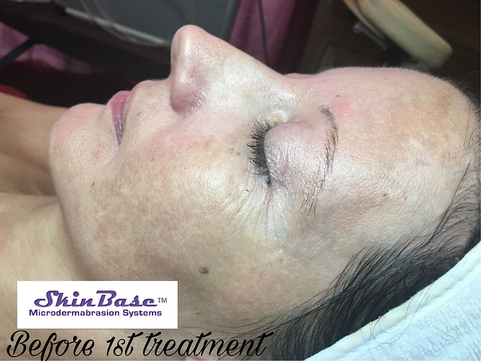 MICRODERMABRASION (3)