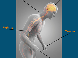 Image of man stooped in Parkinson's posture. Labels indicate common visible signs and symptoms.