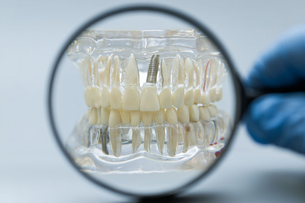Closeup of dental implant model