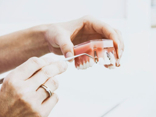 All-on-4 Implants: Complete Guide for Full Mouth Restoration