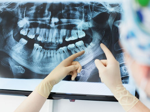Dentures and Bone Loss: How Missing Teeth Affect Your Jawbone Health