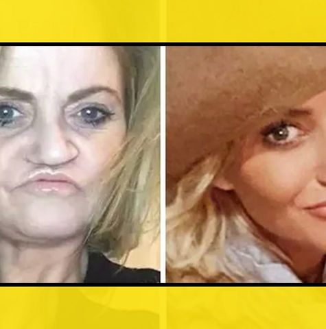 Los huesos faciales de esta actriz han empezado a 'pudrirse'