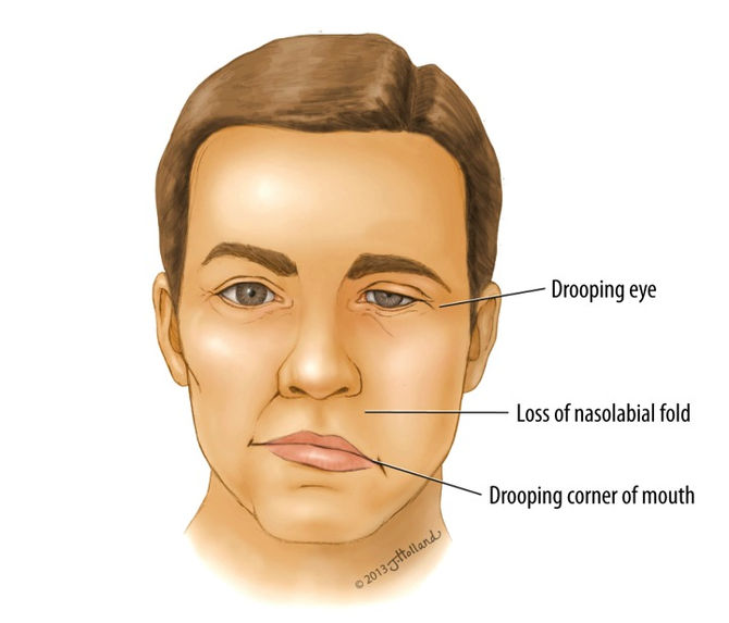 Bell's Palsy and Acupuncture
