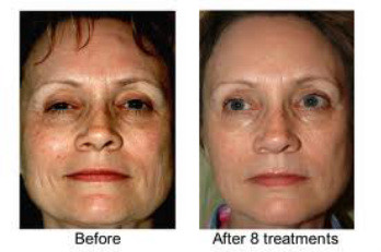 Facial Rejuvenation Acupuncture