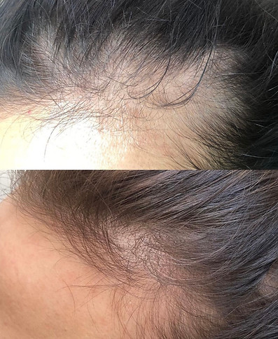 Before and after hair loss injection