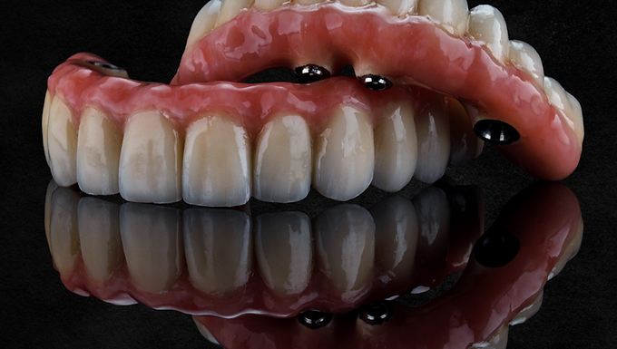 Prótese protocolo sobre implante radiografia Mooca