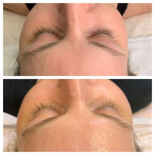 GREEN PEEL Client before and after Fresh Up treatment.jpg
