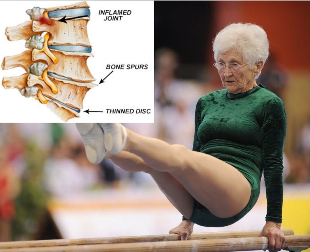 Degenerative Disc Disease Aggravated By Car Accident Captions Viral