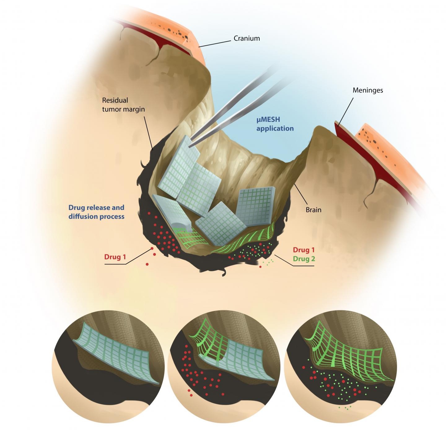 The microMESH has the shape of a micrometric polymeric net, it is made with biodegradable materials and wraps around the tumor mass. Its structure consists of two separate compartments in which different drugs can be loaded which are released towards the tumor mass in an independent, precise, and prolonged fashion. The microMESH can 'attack' glioblastoma by combining different therapies: chemotherapy, nanomedicine, and immunotherapy. @ D. Beghetto/IIT