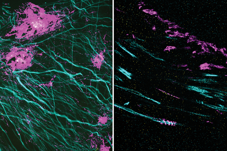 In these two images, the magenta signal is the amyloid-beta nanostructure, revealed by post-expansion staining. The left image shows the thread-like patterns of amyloid-beta nanoclusters, and the right image shows the helical structure of amyloid-beta, which was not revealed using previous techniques. @ Zhuyu Peng and Jinyoung Kang
