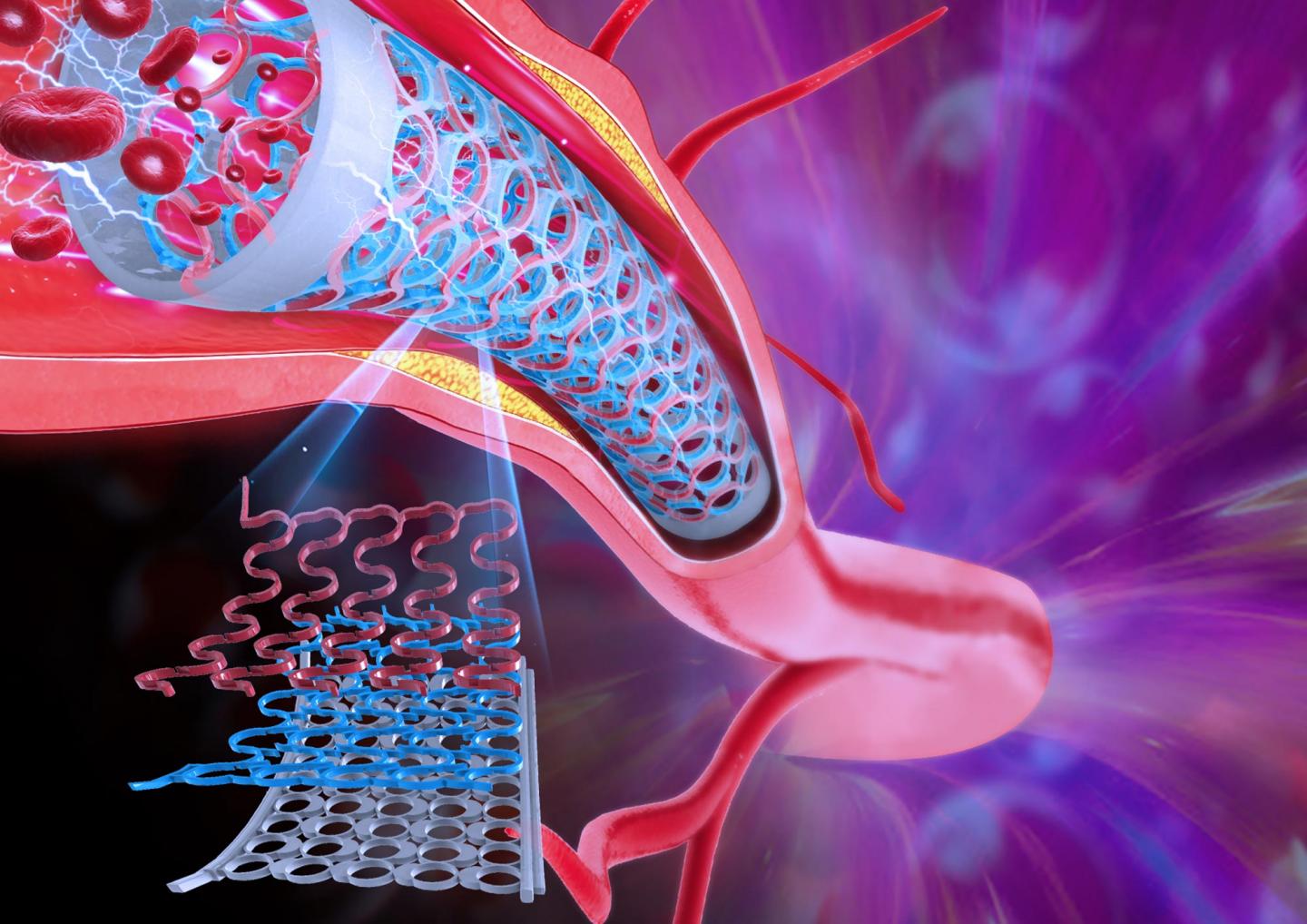 An illustration of the novel self-aware metamaterial system as used in a coronary artery stent. The design can sense restenosis when used in a stent, and the same design can be used at a large scale in bridge beams to to self-monitor for defects on the structure. @ iSMaRT Lab