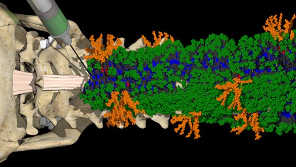 A new injectable therapy forms nanofibers with two different bioactive signals (green and orange) that communicate with cells to initiate repair of the injured spinal cord. @ Mark Seniw