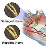 Nerve Repair Surgery.png
