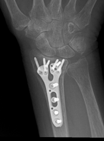 Distal+radius+fracture+surgery+x-ray.webp