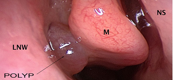 polyp.jpg