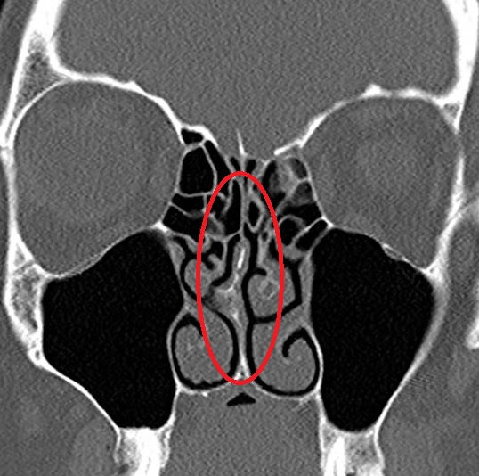 Septoplasty and Turbinate Reduction Combined: Addressing All Causes of Nasal Obstruction