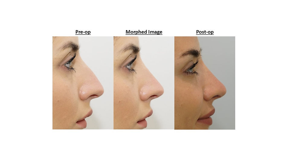 Rhinoplasty Morphing (digital rhinoplasty simulations) in Hampshire