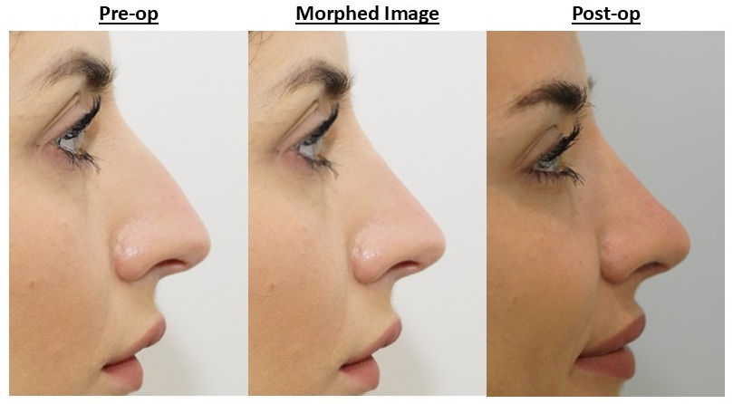 Side-by-side pre-op, morphed, and post-op images demonstrating how rhinoplasty morphing compares with real surgical results performed by Mr Tim Biggs.