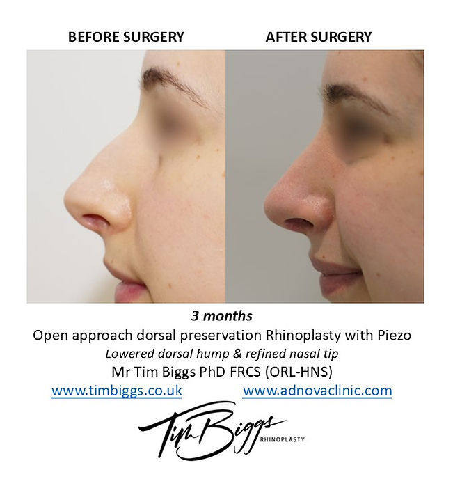 Consultant Cosmetic Rhinoplasty & Sinus Surgeon  Winchester & Fareham Hampshire UK