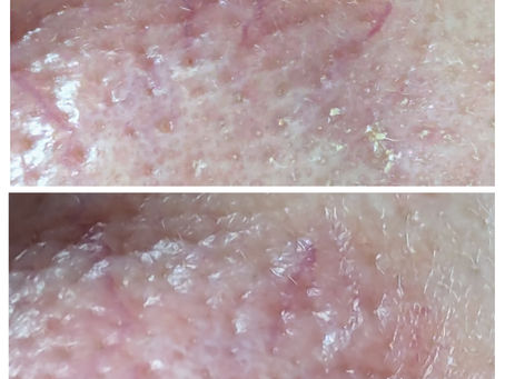 Telangiectasia (Thread Veins)