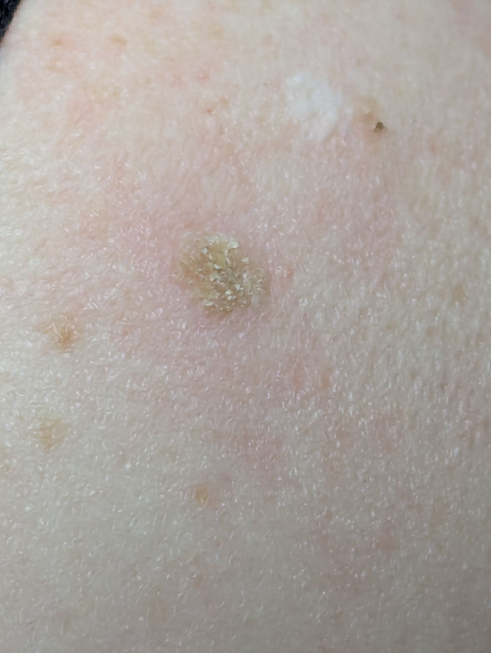 Seborrhoeic Keratosis (SEB K)