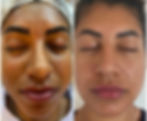 skinbooster