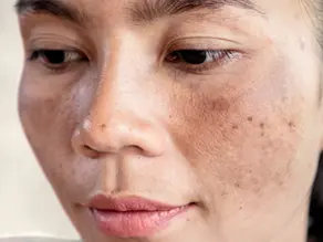 Les taches pigmentaires du visage correspondent à une augmentation localisée de mélanine, pigment naturel responsable de la couleur de la peau. 