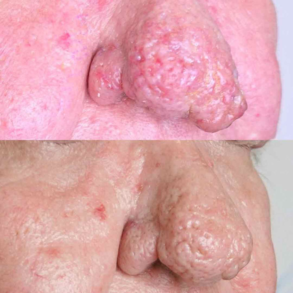 Résultat avant après traitement laser CO2 d’un rhinophyma avec amélioration du relief du n