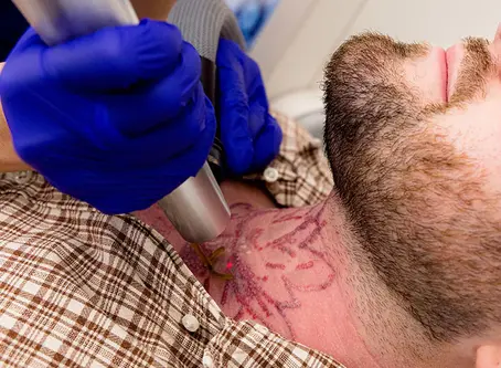 Détatouage laser : combien de séances sont nécessaires selon la couleur et l’ancienneté du tatouage ?