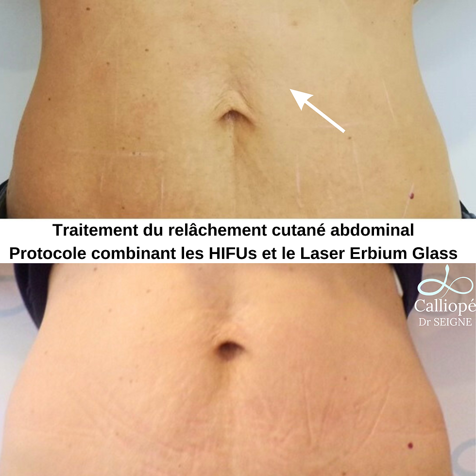 Relachement cutané abdominale
