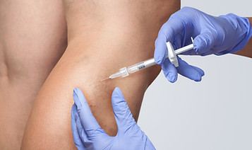 Sclerotherapy