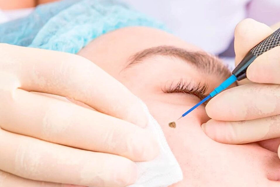 How Warts Removal in Islamabad Can Improve Your Skin Confidence
