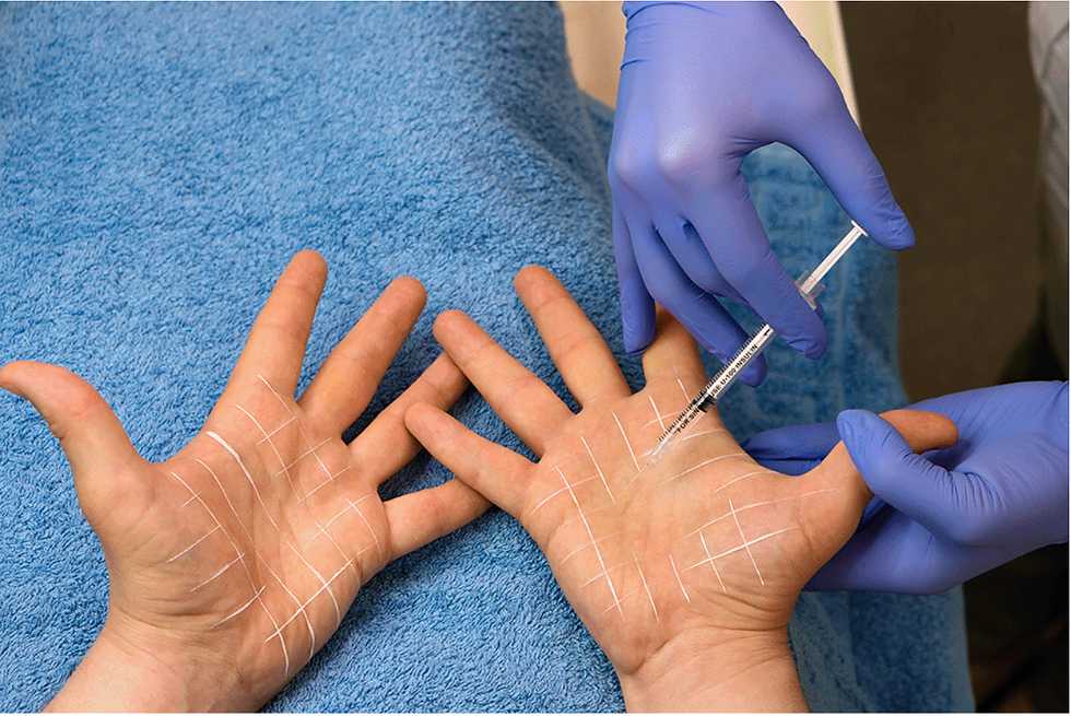 Hyperhidrosis Treatment In Islamabad: Safe and Effective Sweat Control Methods