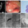 Self-expandable metal stents associated with higher cost and more complications vs balloon dilation for benign gastric outlet obstruction