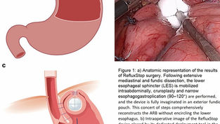 Five-year outcomes reveal RefluxStop surgery can offer sustained safe and effective relief from GERD