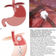 Five-year outcomes reveal RefluxStop surgery can offer sustained safe and effective relief from GERD