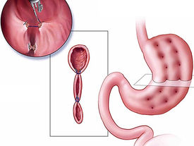 ESG represents a safe, minimally invasive and versatile intervention for obesity