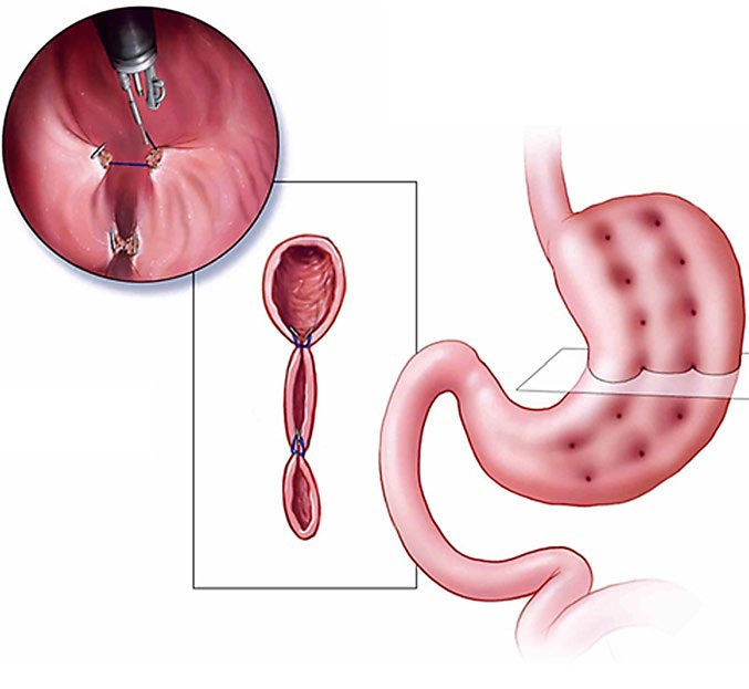ESG represents a safe, minimally invasive and versatile intervention for obesity