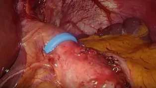 MiniMizer Ring and pouch resizing effective for symptom control in patients with dumping syndrome and post-bariatric surgery hypoglycemia