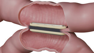 Biofragmentable magnetic anastomosis system is feasible, safe and effective in achieving incisionless, suture- or staple-free MagDI bipartition