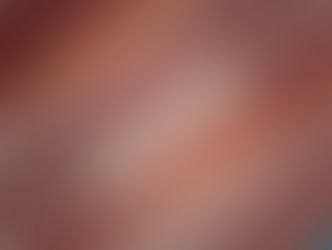 Magnetic compression simplifies revisional sleeve gastrectomy