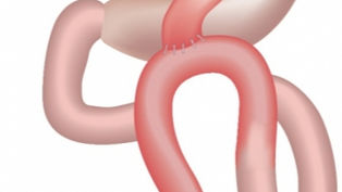Despite positive outcomes from OAGB, improvements required in reporting of surgical techniques, outcome definitions and long follow-up