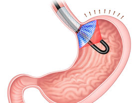 Intragastric satiety-inducing device – a novel endoscopic bariatric therapy