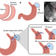 Researchers develop the Lily stent to treat gastric ulcers