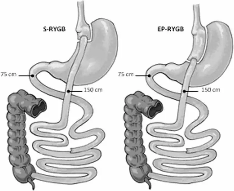 Anatomy of the surgical procedures. S-RYGB Standard Roux-en-Y gastric bypass, EP-RYGB Extended pouch Roux-en-Y gastric bypass
