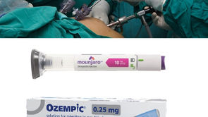 Bariatric surgery facing upheaval amid growing GLP-1 use