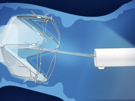 Morphic Medical gains CE Mark for RESET endoscopic device
